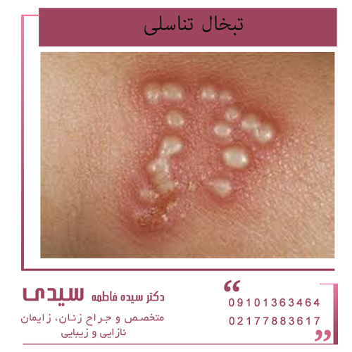 درمان تبخال تناسلی