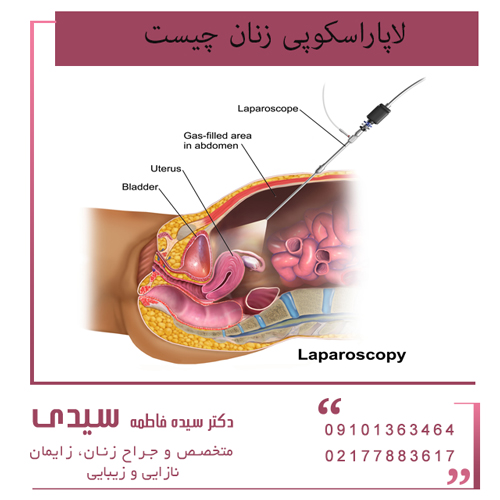 لاپاراسکوپی زنان