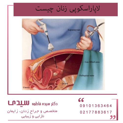لاپاراسکوپی زنان