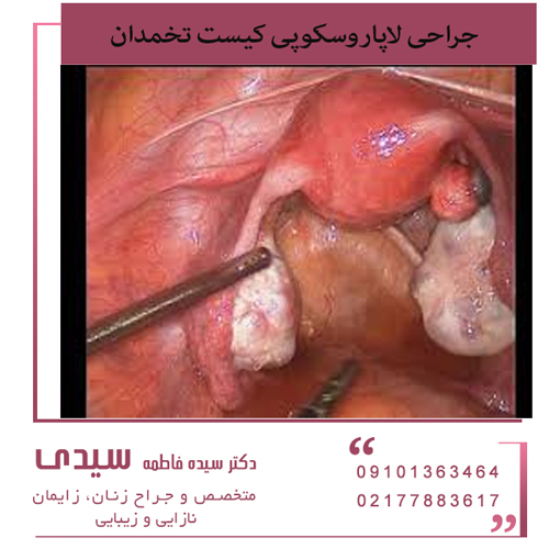 لاپاراسکوپی-تخمدان