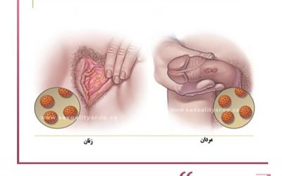 زگیل تناسلی؛ روش‌های تشخیص، درمان و پیشگیری
