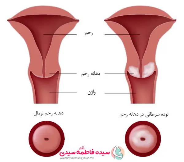 درمان سرطان سرویکس