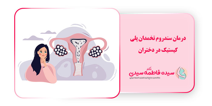 روشهای درمان سندروم تخمدان پلی کیستیک در دختران