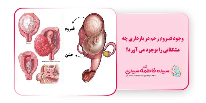 وجود فیبروم رحم در بارداری چه مشکلاتی را بوجود می آورد؟