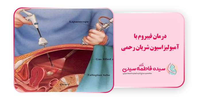 درمان فیبروم با آمبولیزاسیون شریان رحمی