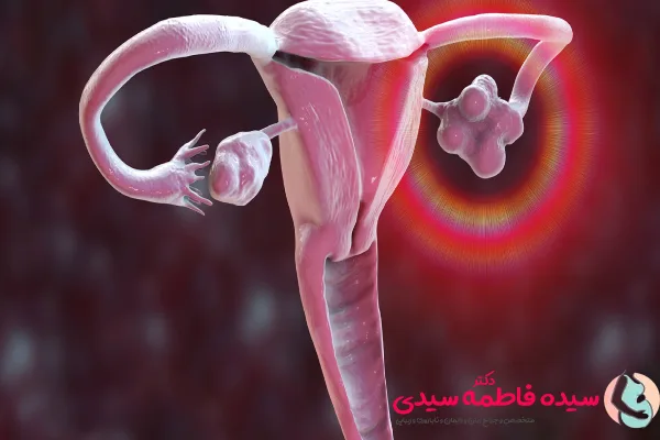 روش های درمان سندروم تخمدان پلی کیستیک
