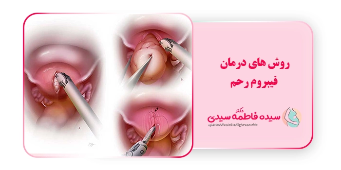 روش های درمان فیبروم رحم