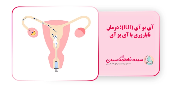 آی یو آی (iui)؛ درمان ناباروری با آی یو آی
